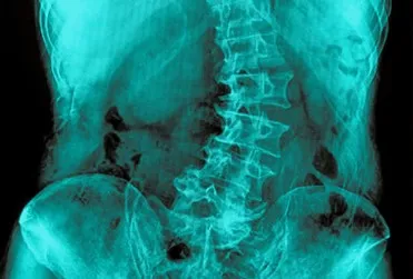 Chiropractic Mt Laurel Township NJ X Ray